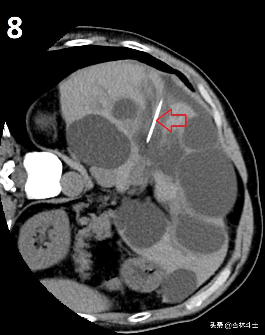 64岁银行职员患肝囊肿,CT引导下细针穿刺抽吸酒精硬化解决大问题