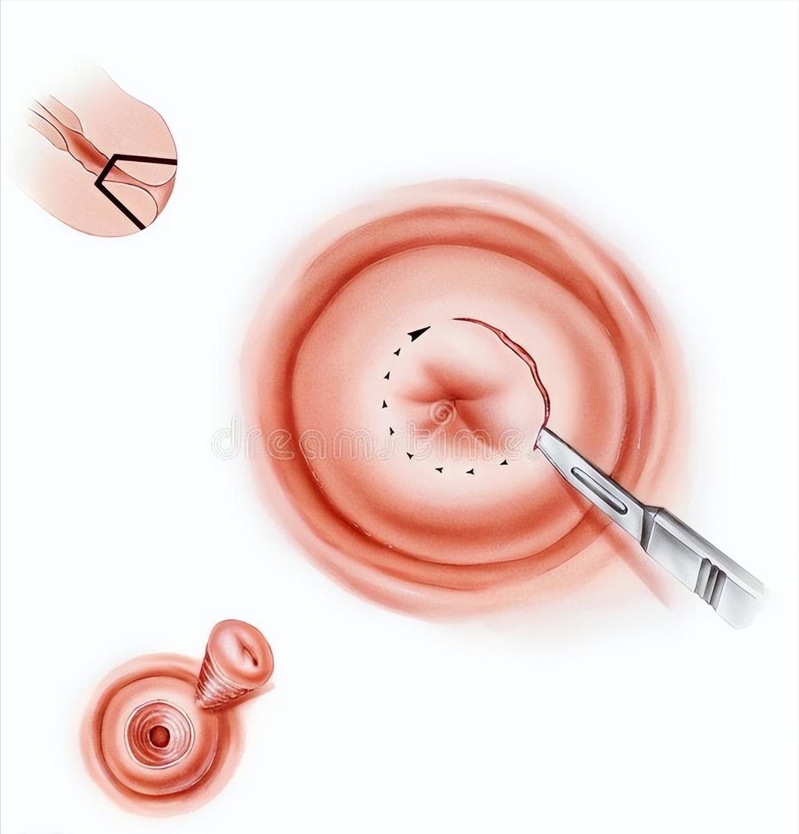 派特灵派特生物科普｜如何减少宫颈锥切术后切缘阳性的发生