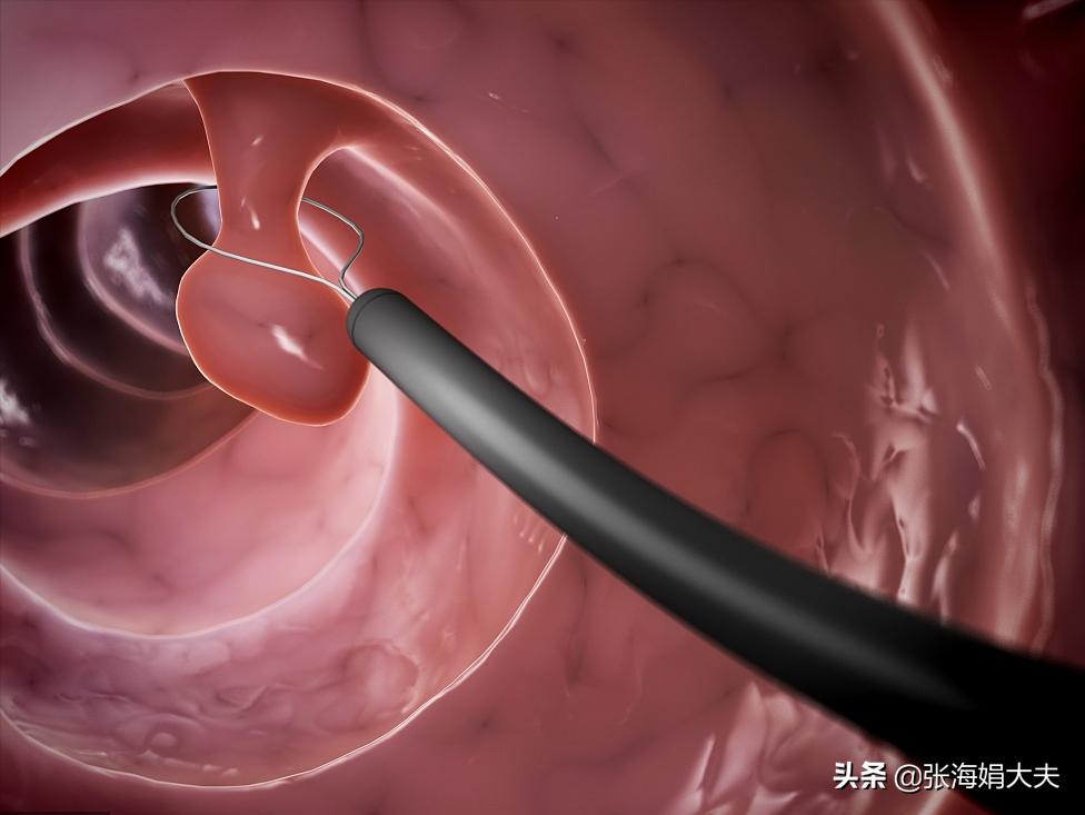 宫颈息肉是怎么形成的原因,宫颈息肉赘生物是怎么形成的呢