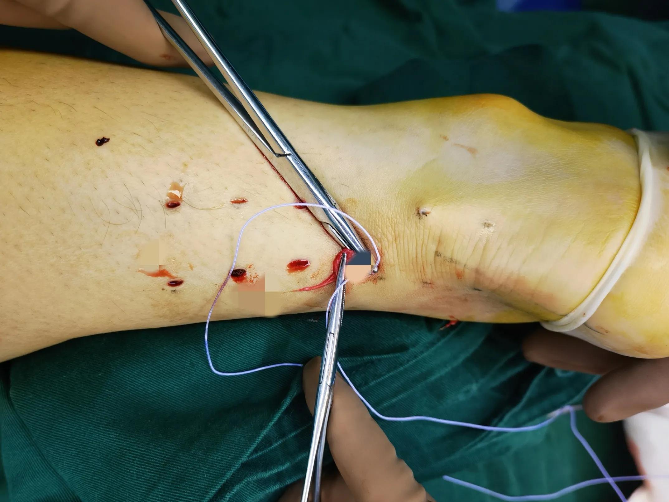 跟腱断裂术后疤痕增生怎么办,跟腱断裂术后跟腱如何愈合