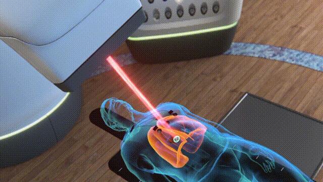 肺癌早期做射波刀,咳嗽有痰做体检查出肺癌严重不