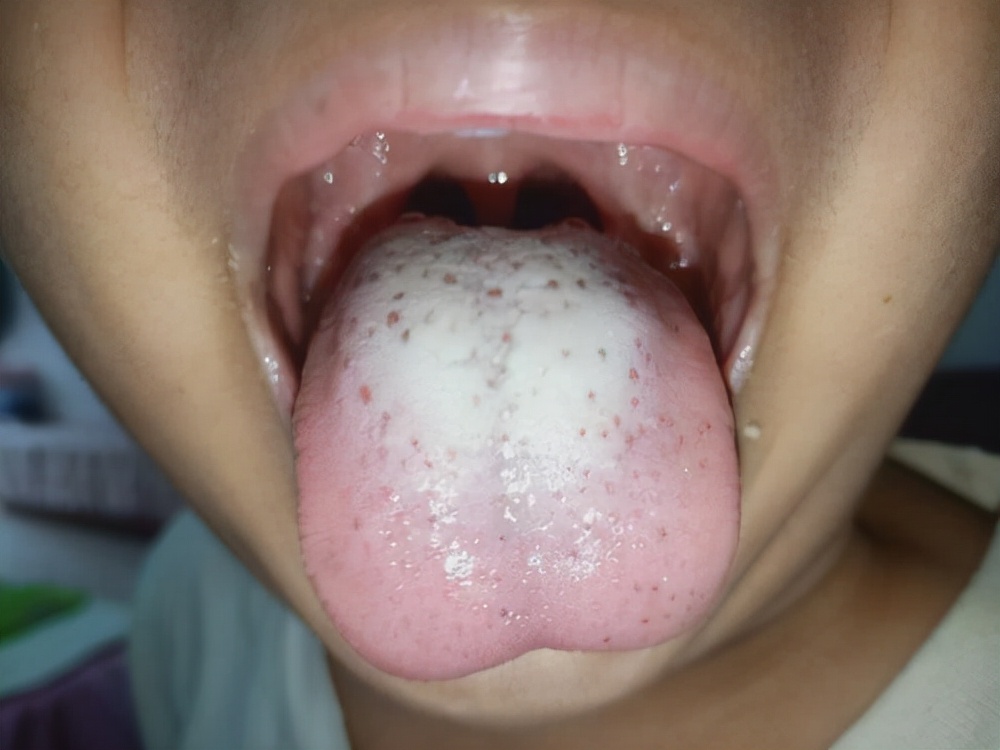 舌苔厚腻的原因西医,舌苔厚白腻是怎么回事如何调理