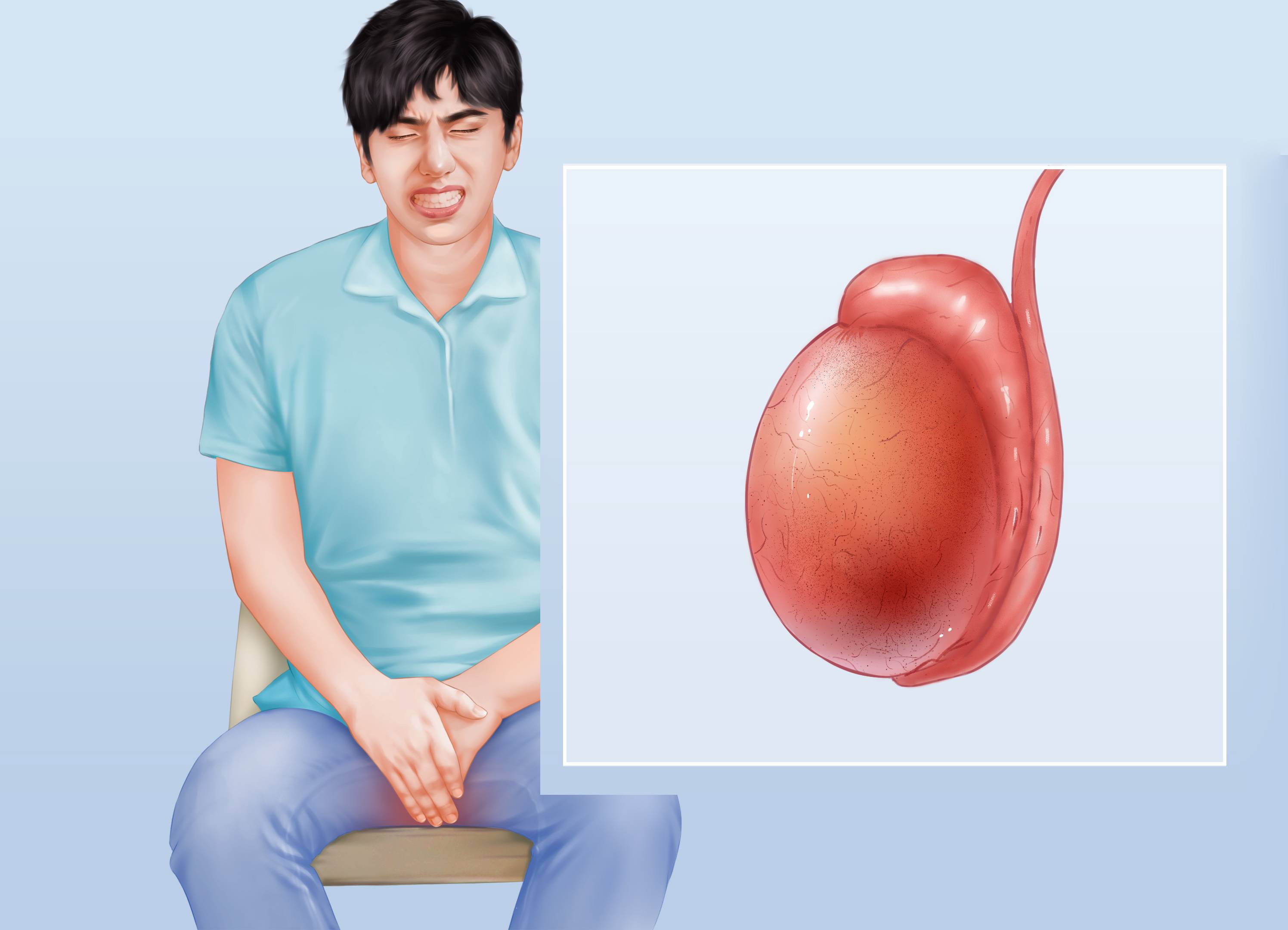 婚后生育半年没有排精,老公引起附睾*丸睾**炎?