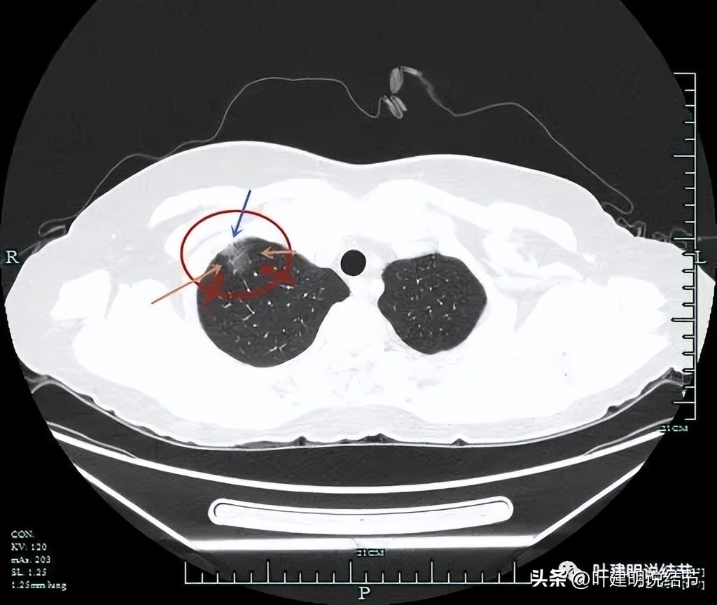 肺癌病理的肿块是硬的吗,肺癌病灶什么样