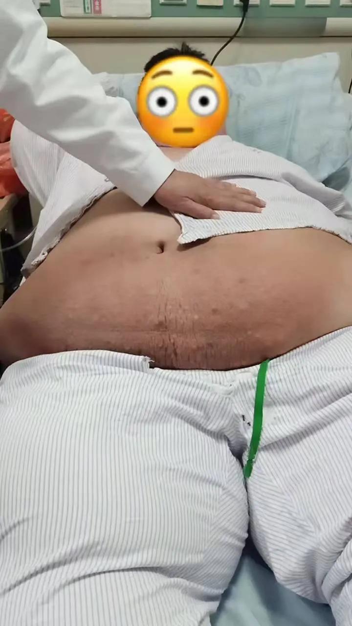 「案例」“广州巨臀”两年长胖两百斤？