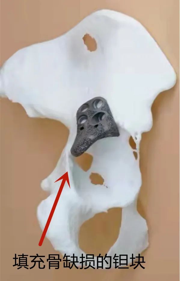 【前沿医术】3D打印，实现髋关节“私人订制”