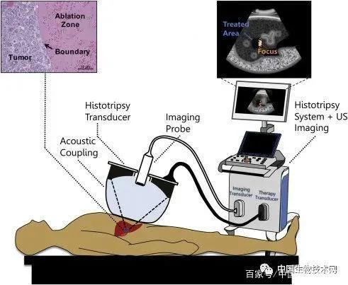 科学家肝癌能治愈吗,科学家何时能彻底治愈肿瘤