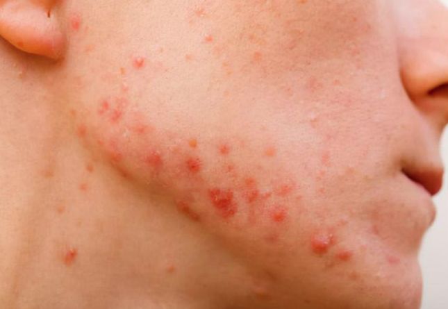 毛孔粗大如何改善且不留痕迹,毛孔粗大如何改善治愈系