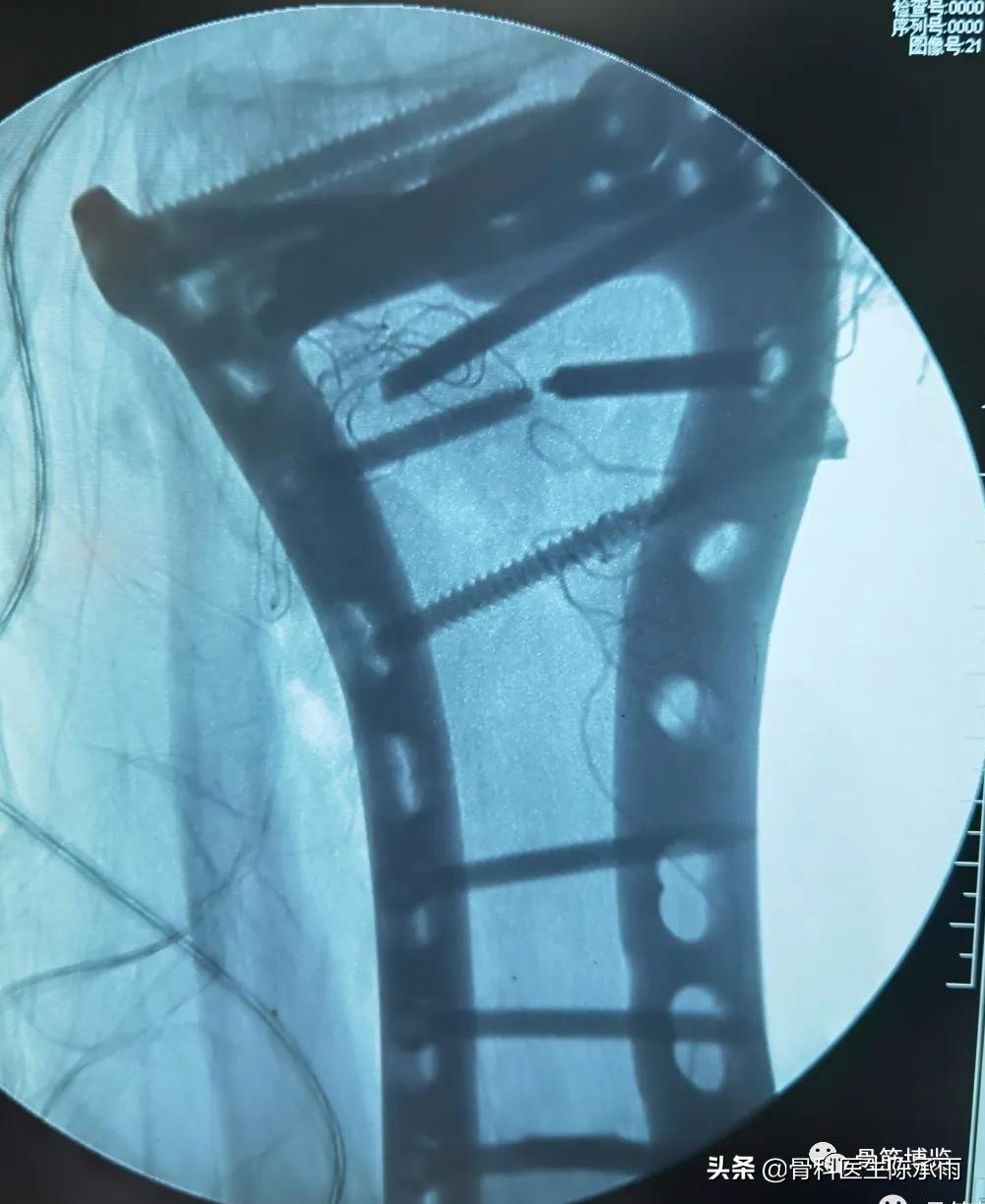 陈旧性腿骨骨折,陈旧性骨折