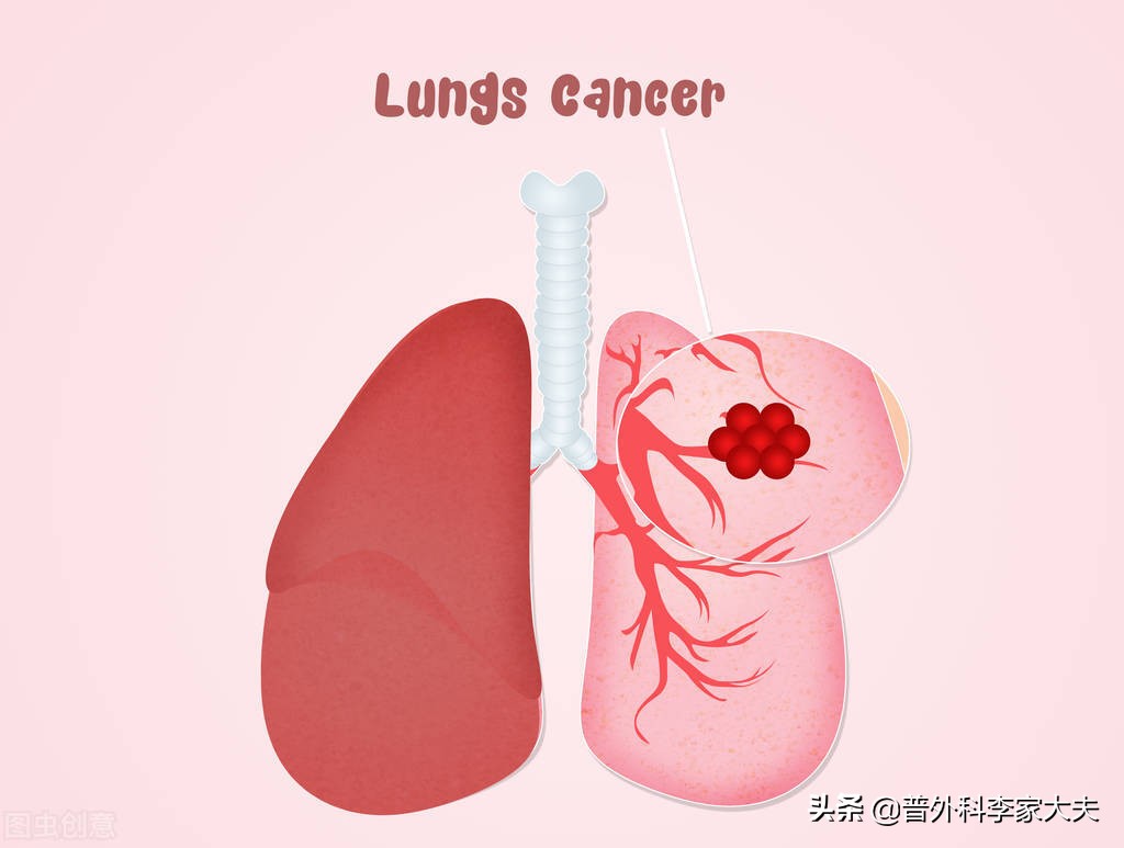 肺癌晚期转移淋巴结能完全治愈吗,从一期肺癌到二期肺癌发展时间