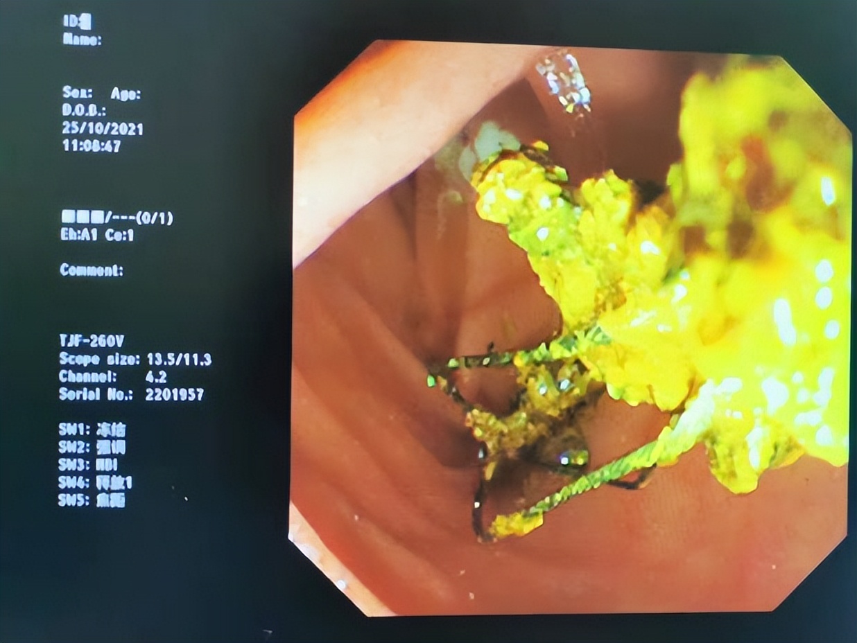肚子痛一定是肠胃有问题了吗,如何分清肚子疼和胃痛