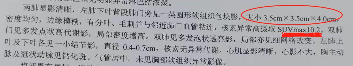 PET/CT病例（6）：4.0cm肺癌治疗后缩小到1cm，来看看治疗方案