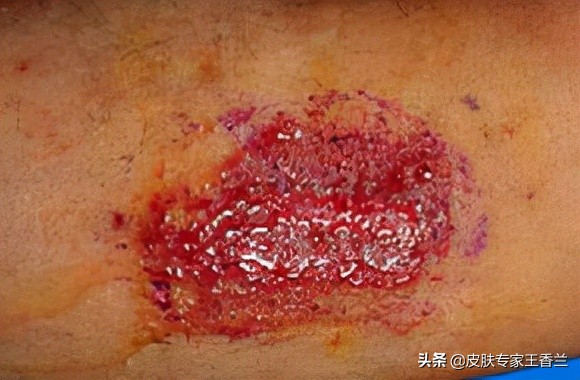 湿疹！到底是皮肤太湿，还是皮肤太干？