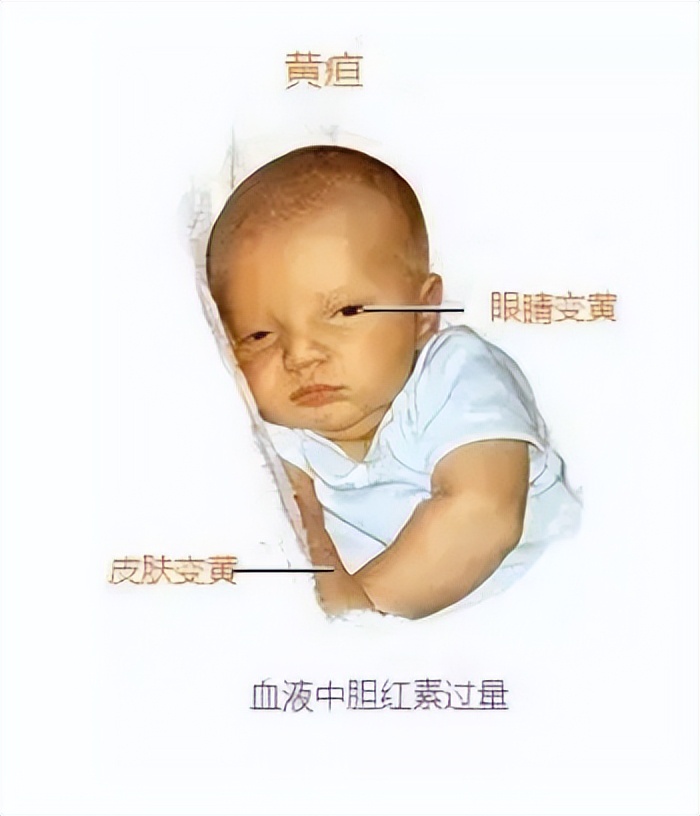 新生儿的黄疸知识宣教,对家长介绍新生儿黄疸的相关知识