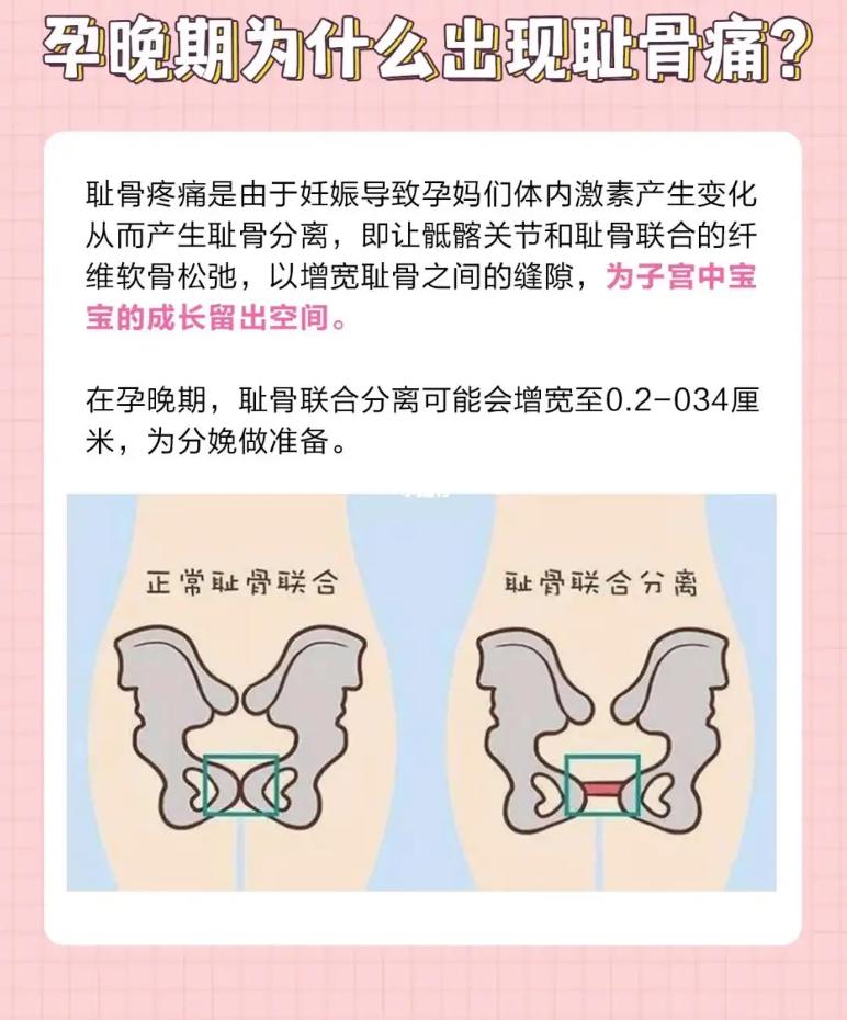 孕期耻骨疼怎么办？如何缓解？
