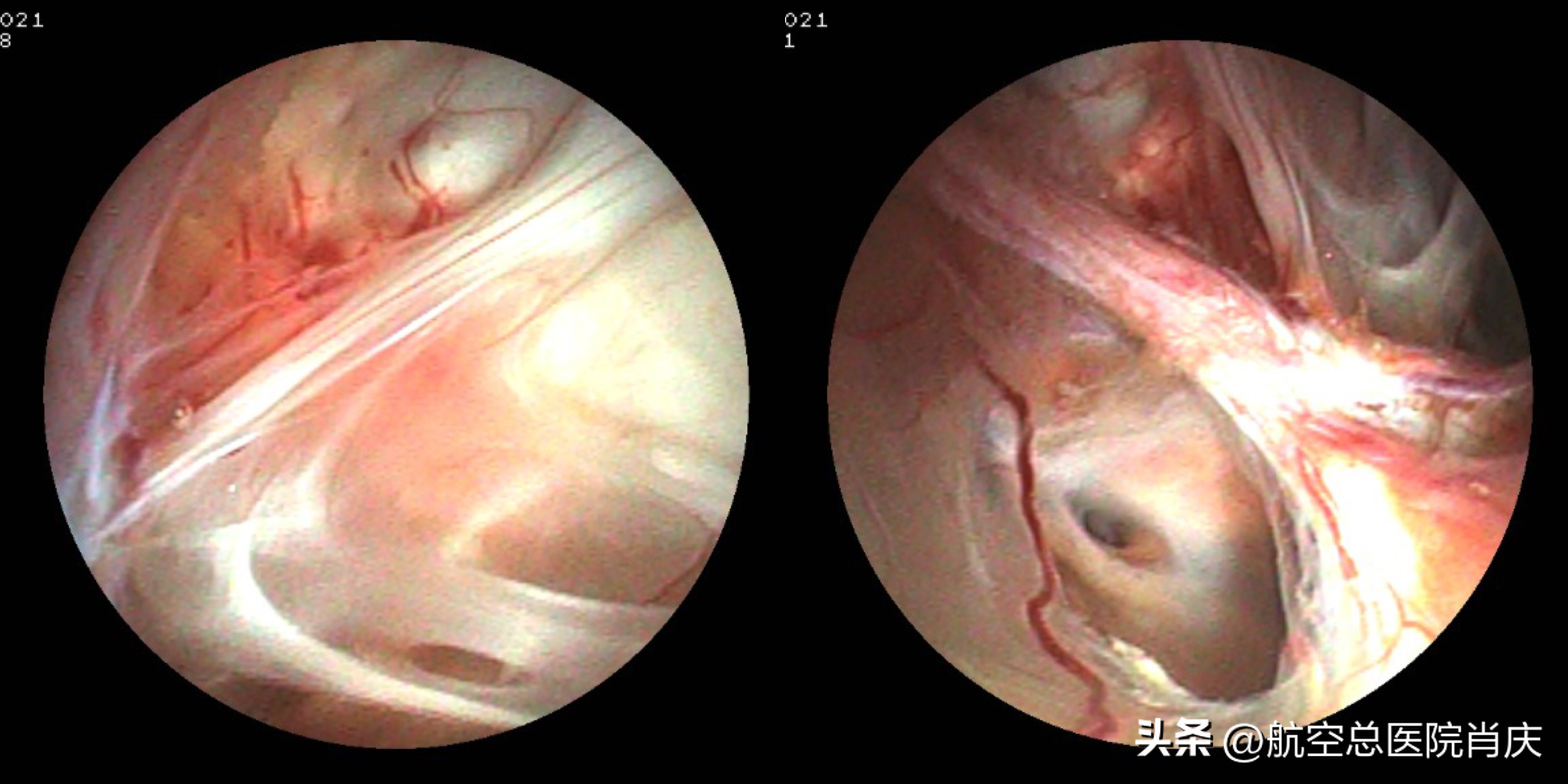 神外医生微创,神外教授手术