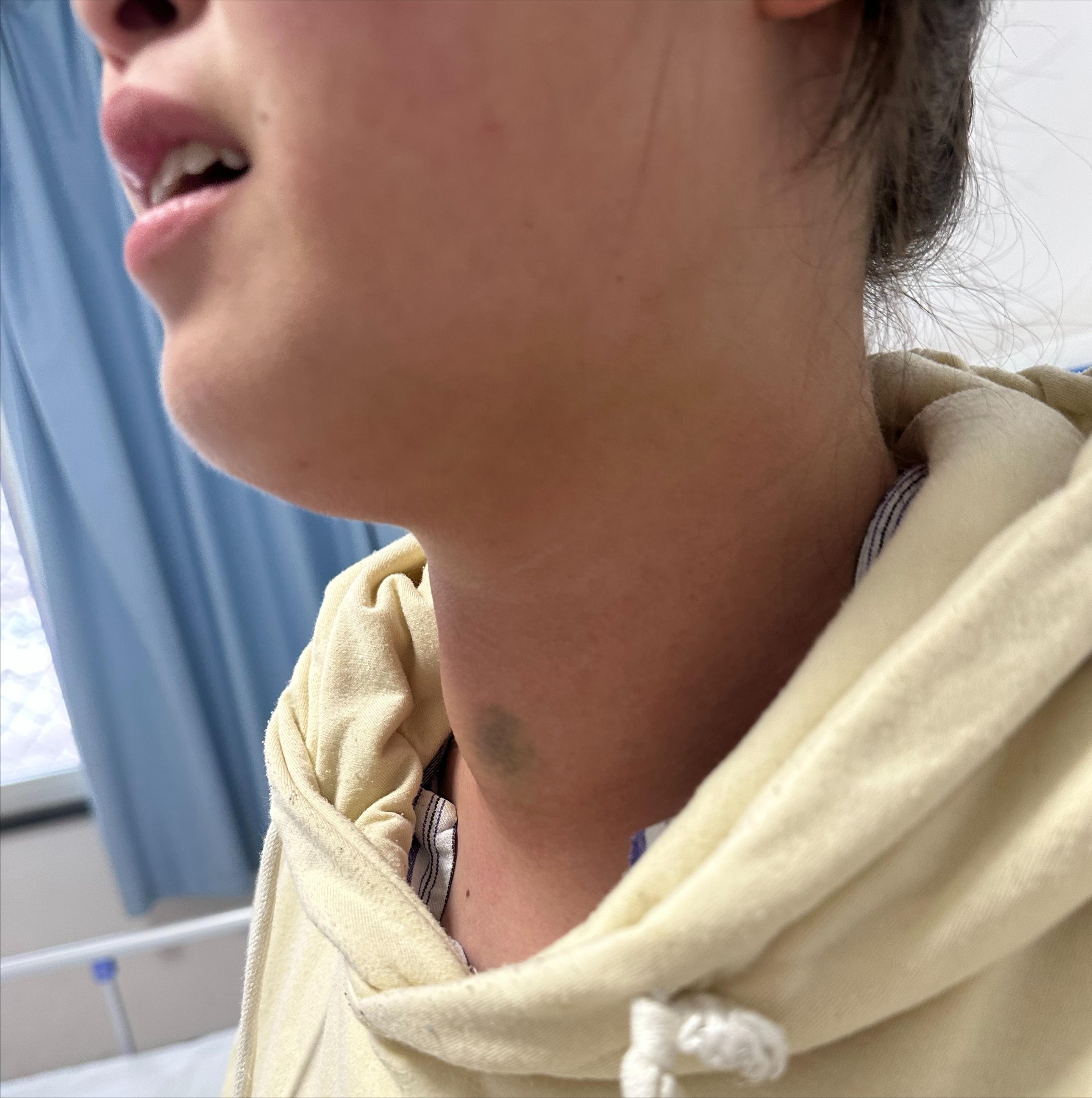 甲状腺疾病不容易感染新冠,甲状腺有问题的感染新冠会严重吗