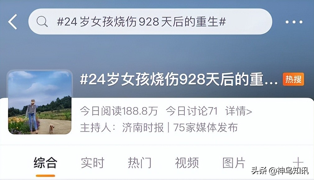 烧伤928天后重生的女孩,24岁女孩曾遇汽车自燃三度烧伤