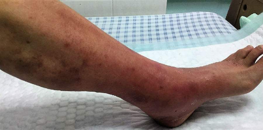 便宜好用的四妙丸，不仅清热利湿，还可适用于这5种病