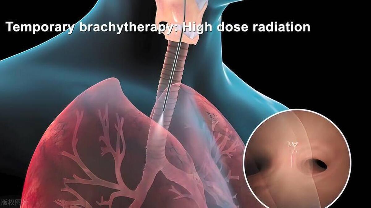 肺癌ia期五年生存率,ib肺癌生存率