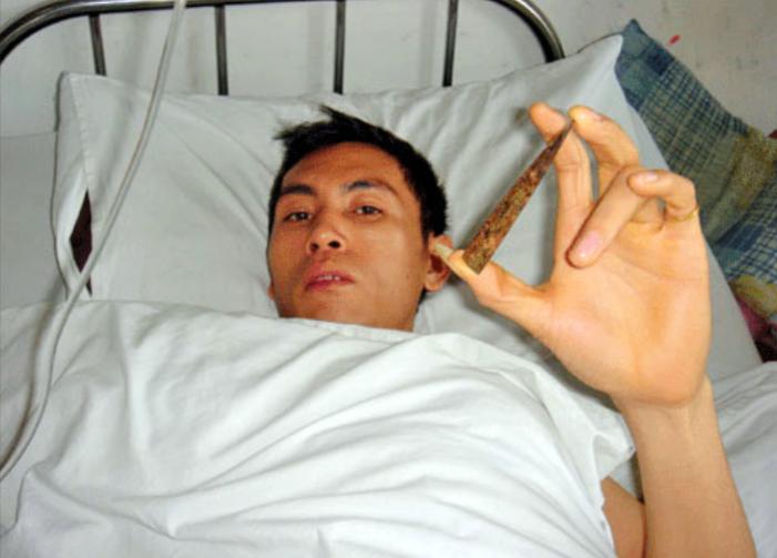 云南男子被妻子按摩到吐血，去医院检查，医生：你脑袋里插了把刀