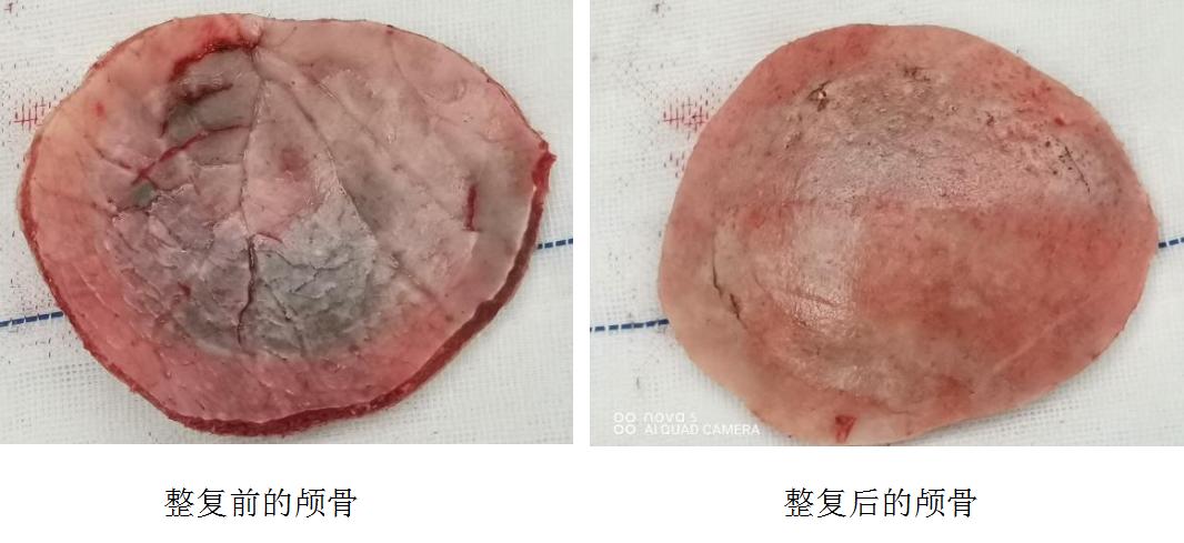 飞来横祸，初中生脑袋被铅球砸出一个“坑”