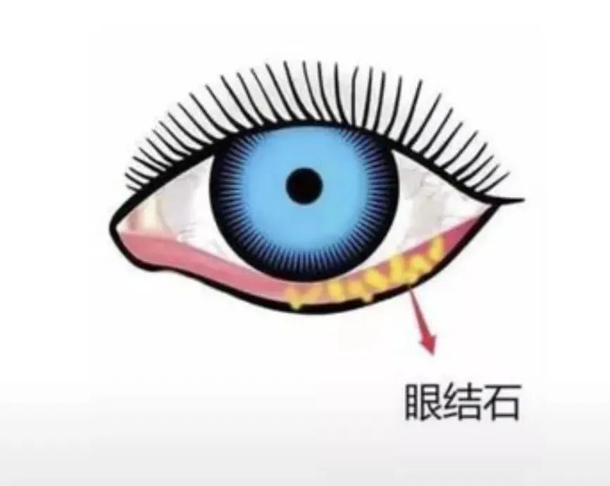 眼结石会眼角膜变薄吗,眼角膜有结石怎么治疗