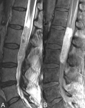 原发性肝癌的磁共振影像诊断,原发性腰椎肿瘤有哪些