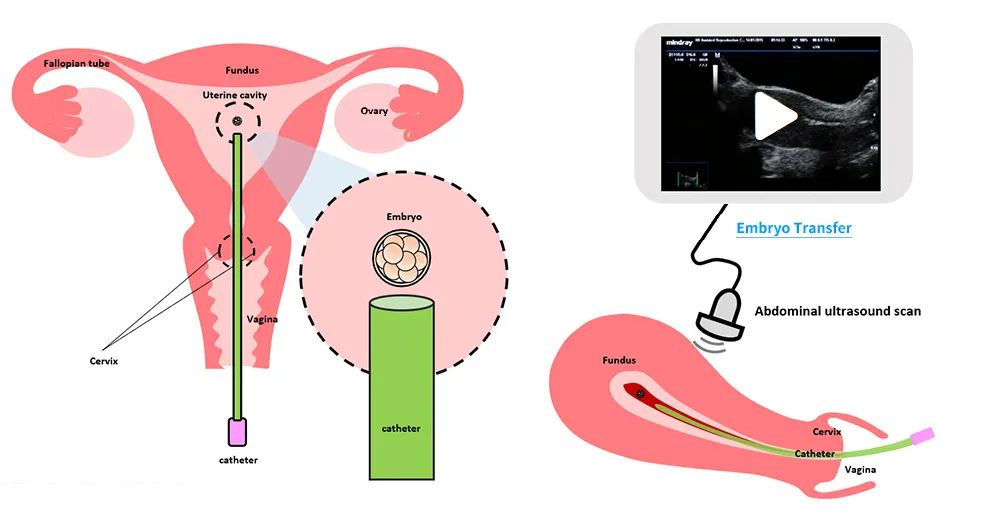 胚胎移植后有吃保胎丸的吗,胚胎移植后需要用什么药