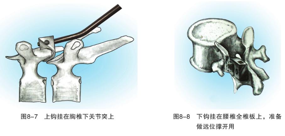 骨科基础：脊柱后侧凸截骨术