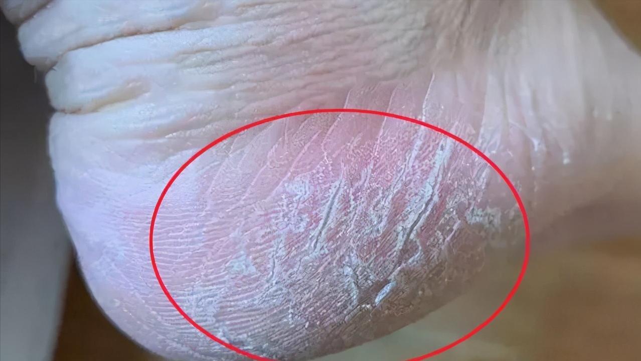 脚后跟干裂是什么原因造成的,为什么脚后跟容易干裂如何应对
