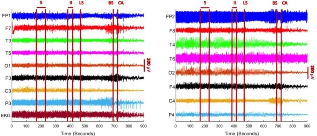人类濒死脑电波,科学家记录濒死脑电波