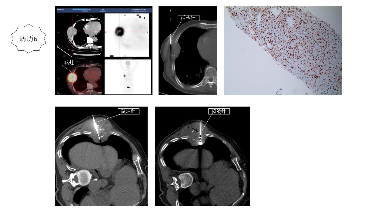 肿瘤局部消融的病历举例
