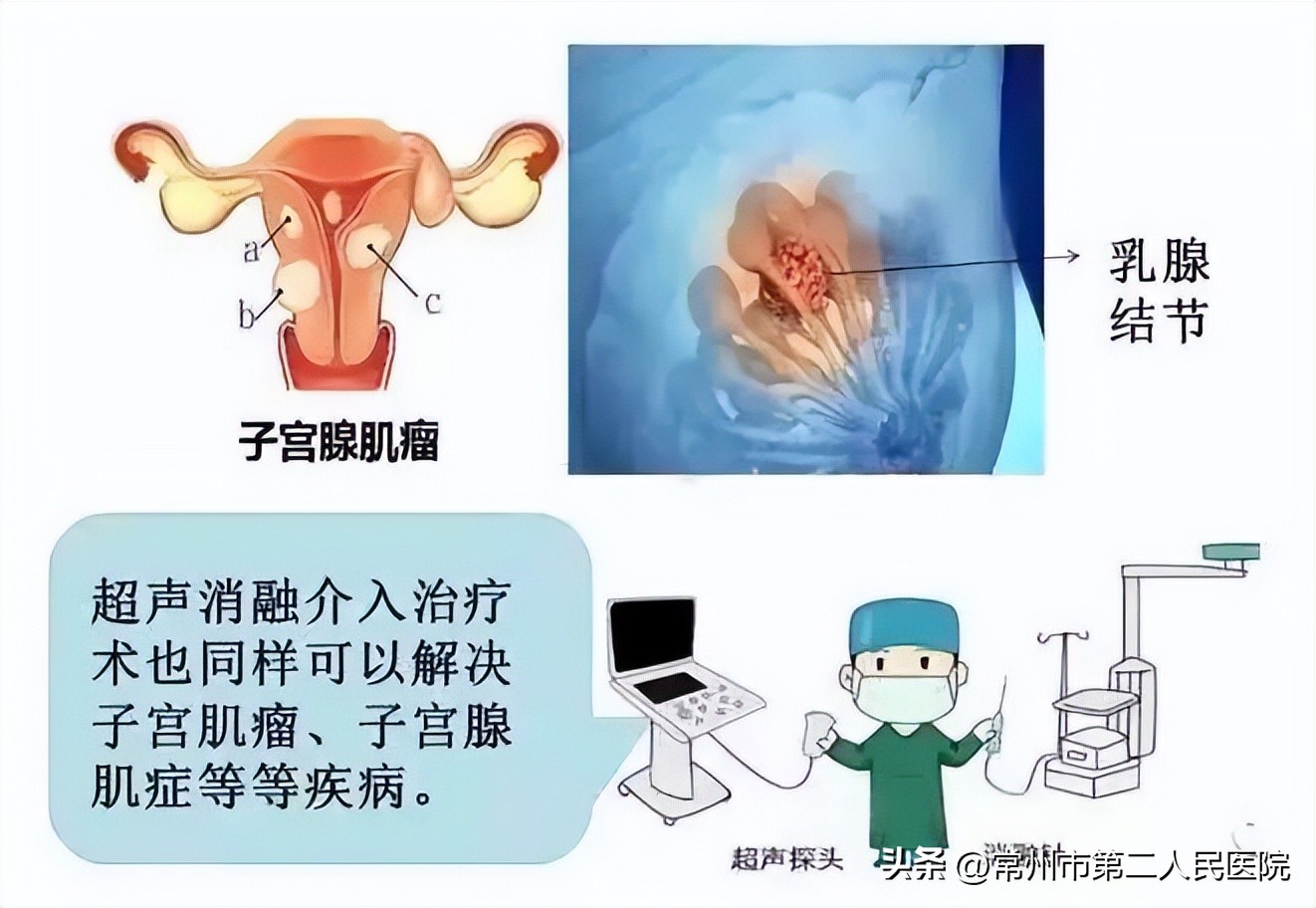 小针孔，用途多，漫画带你了解介入超声能做啥？