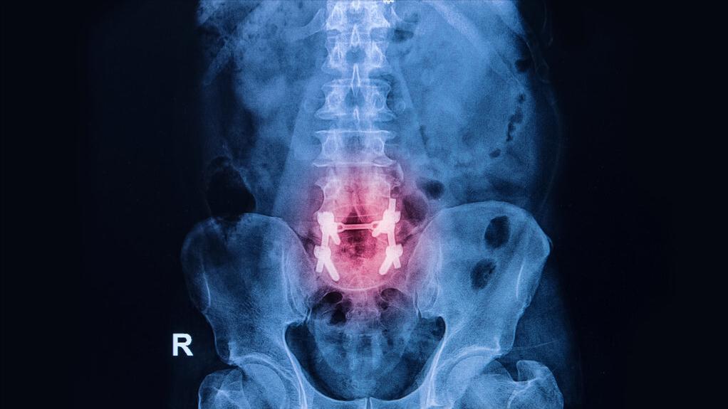 腰椎做了手术还能弯腰吗,腰椎手术能坐轮椅吗