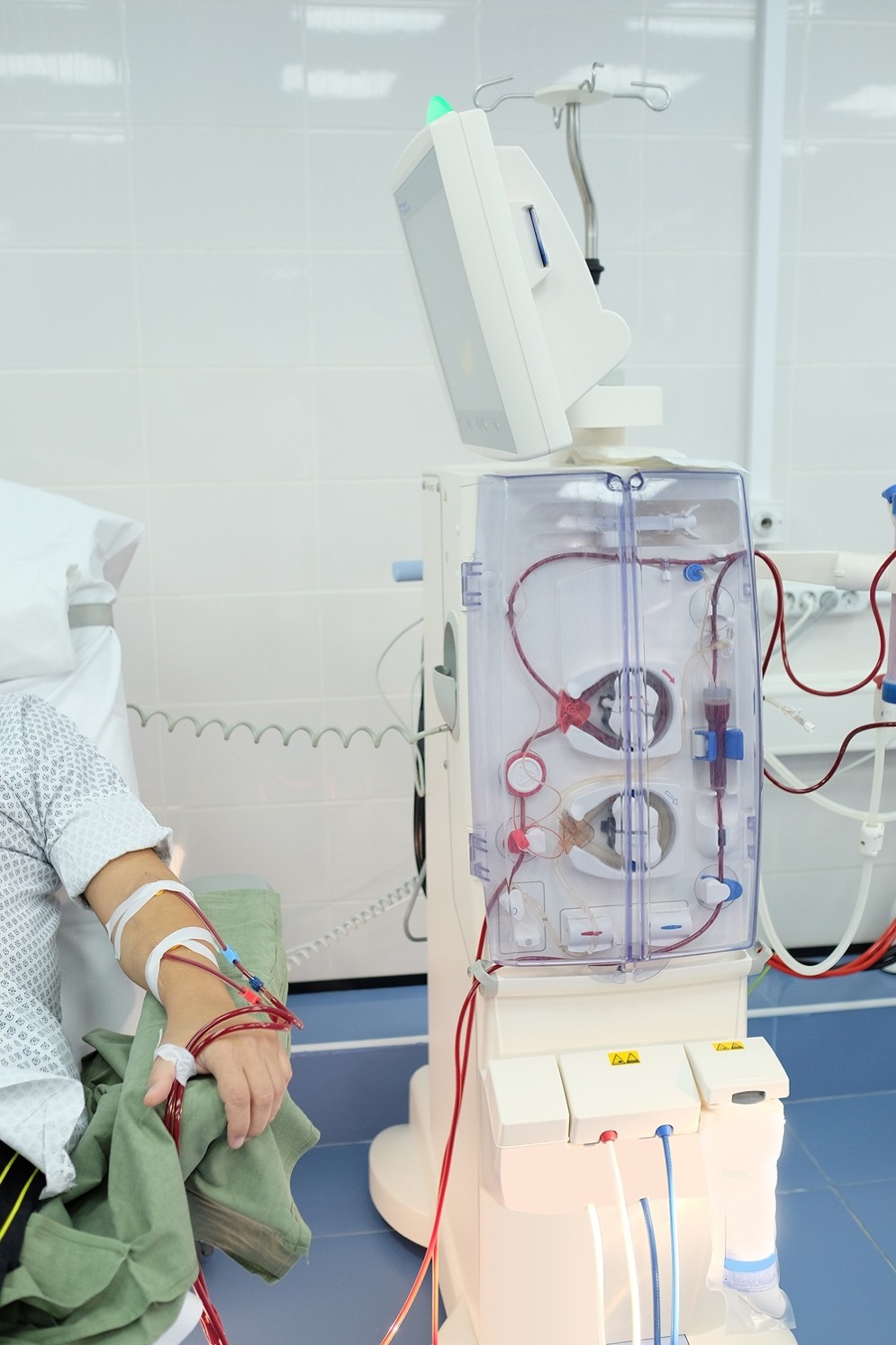 肾脏水泡如何处理,肾脏水泡