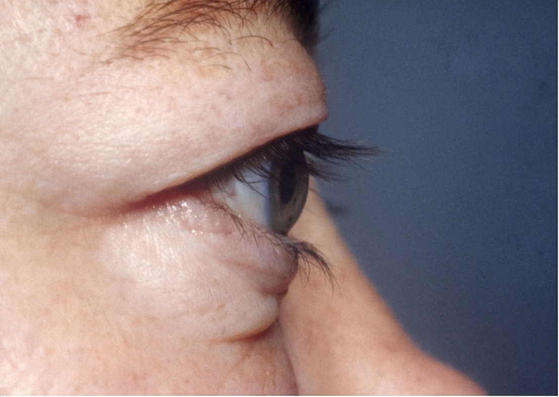 甲亢引起焦虑抑郁症怎么办,甲亢引起焦虑症