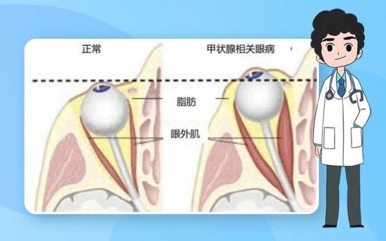 通过查眼睛能判断糖尿病吗,糖尿病眼科疾病的症状