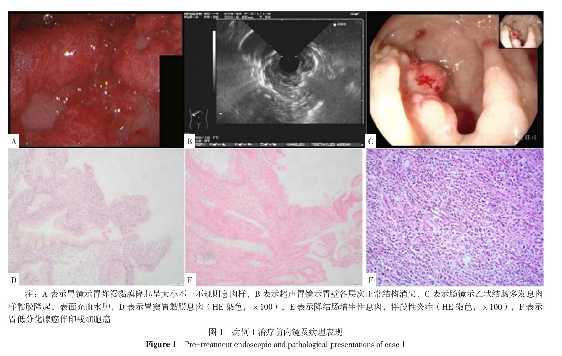cronkhite-canada综合征能治愈吗 (cronkhite-canada综合征)
