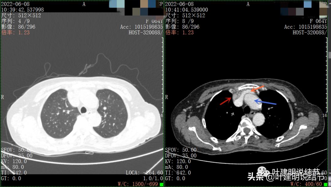 这位老乡，乏力来查，查出这么大个的纵隔肿瘤！会是什么呢？
