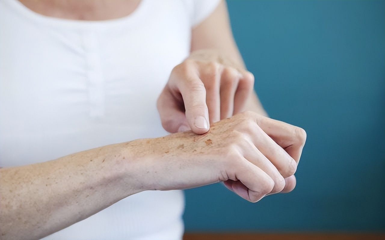 为啥老人斑会自行掉了,有人说红霉素软膏治老年斑