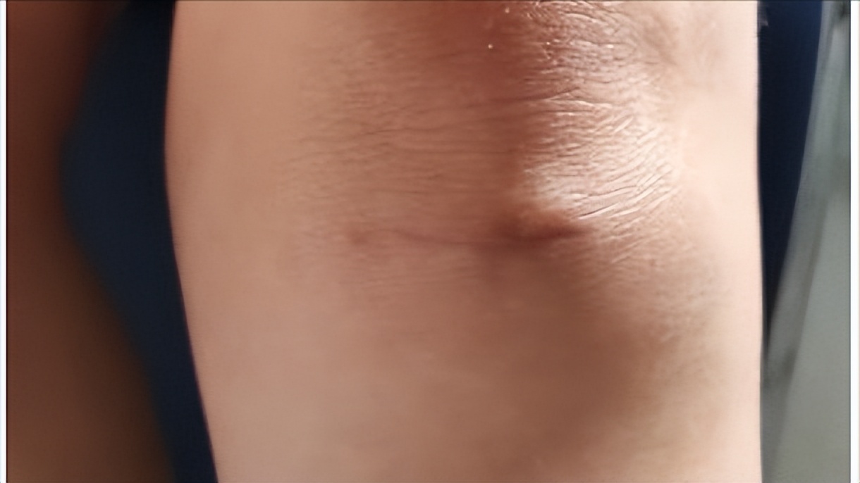 德国断骨增高20厘米,德国最新断骨增高术