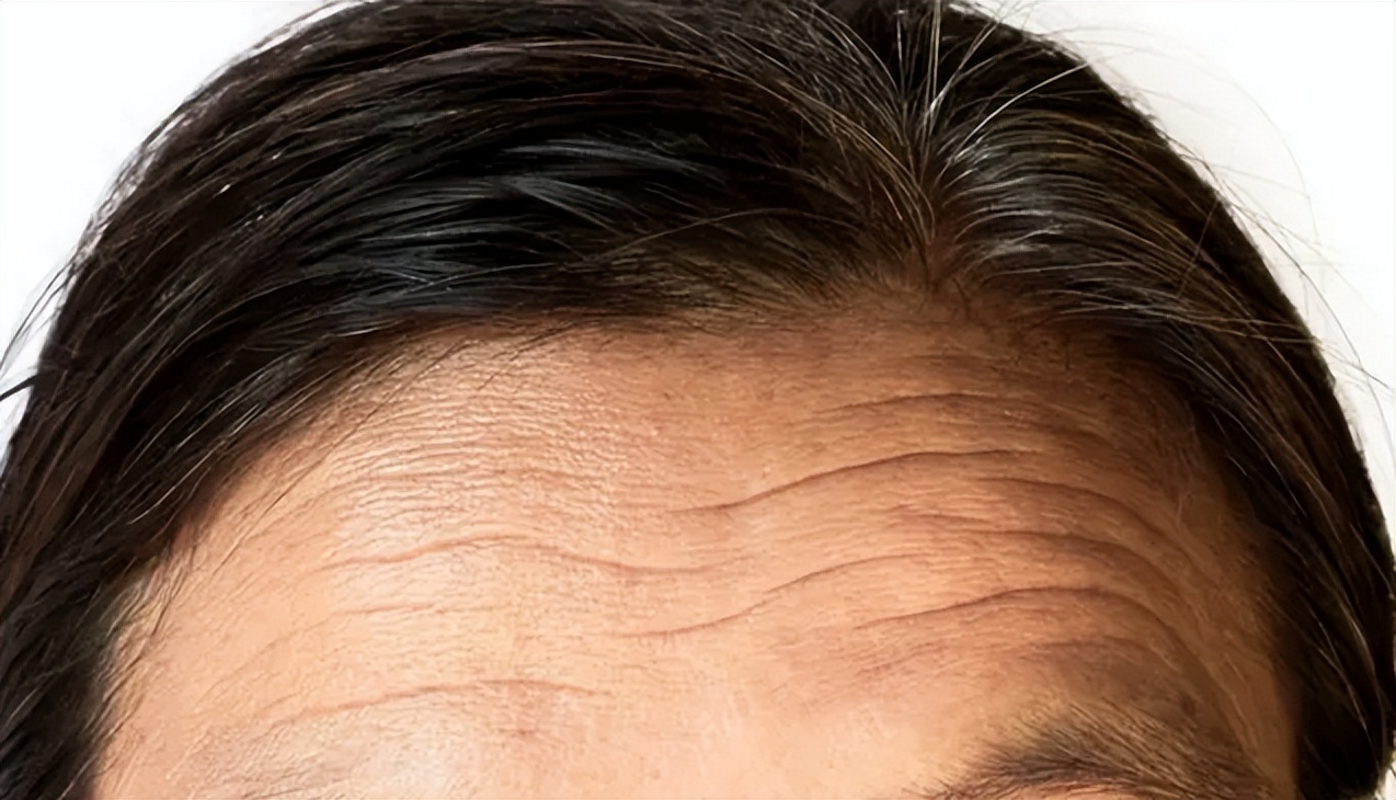 有效抗皱改善抬头纹,学生抬头纹怎么改善