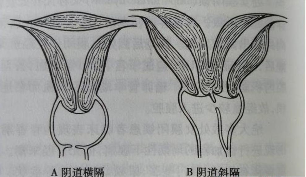 24岁女孩检出两个阴道，还有双子宫？医生解答，详细告诉你怎么办