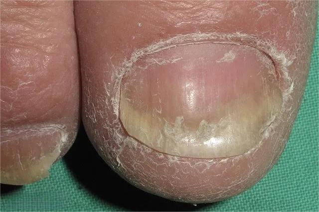 甲癣不严重怎么治疗,甲易生治疗灰指甲吗