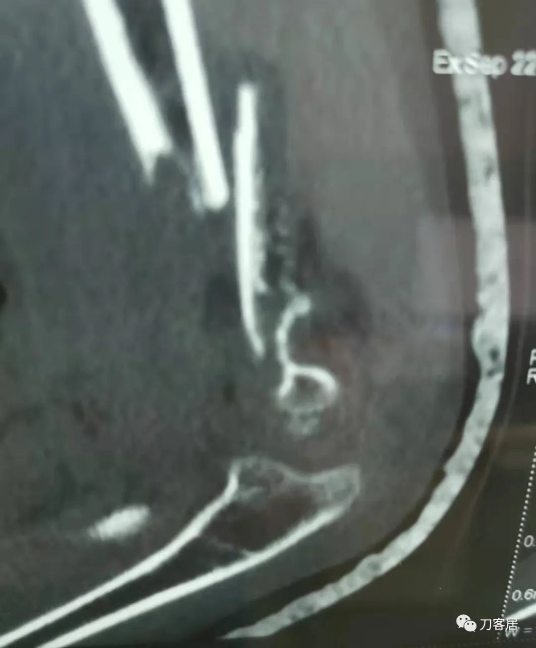 孩子胳膊摔伤肿了不能弯曲一直疼,9岁男孩摔倒手臂痛怎么办