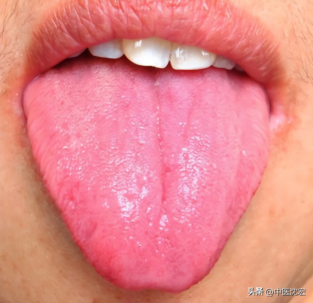 舌头偏红也有舌苔怎么调理,舌红舌胖有裂纹