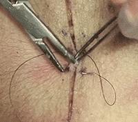 外科缝合技巧你熟练吗,外科缝合术的操作步骤