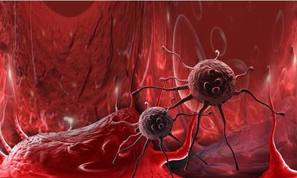 癌症根本不需要治，治好的都是误诊了？医生告诉你4个真相