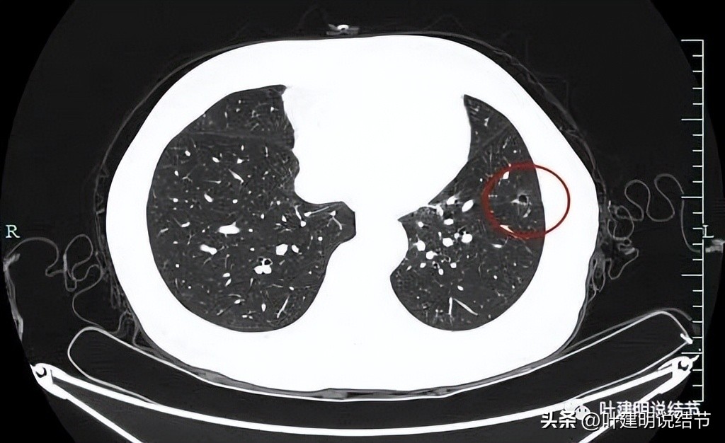 辽宁省肺结节手术哪家医院好,辽宁肺结节手术医院